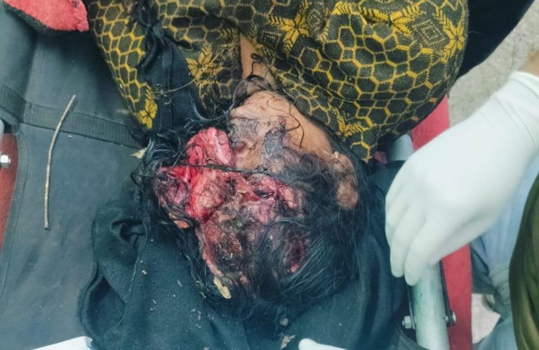 भालू के हमले में महिला गंभीर रूप से घायल,ग्रामीणों में दहशत