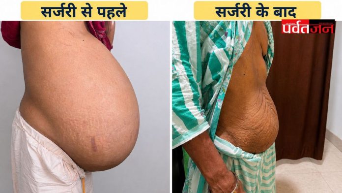 Ovarian Tumor Surgery
