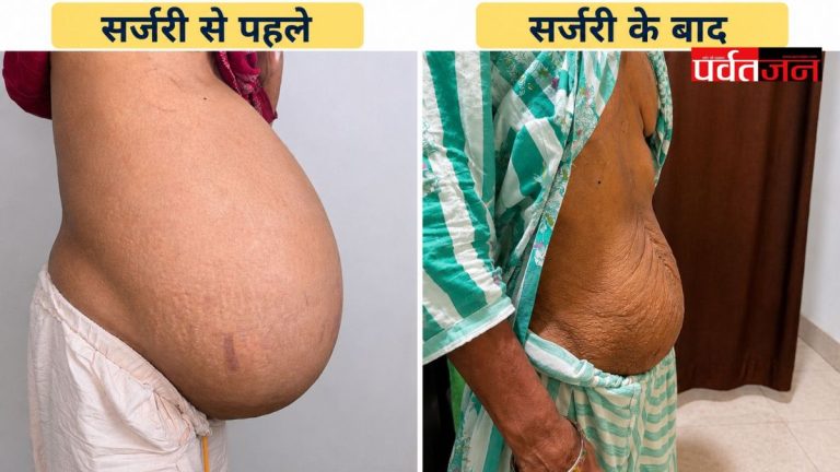 Ovarian Tumor Surgery